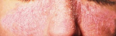 Lupus Entzündung Ekzem Haut