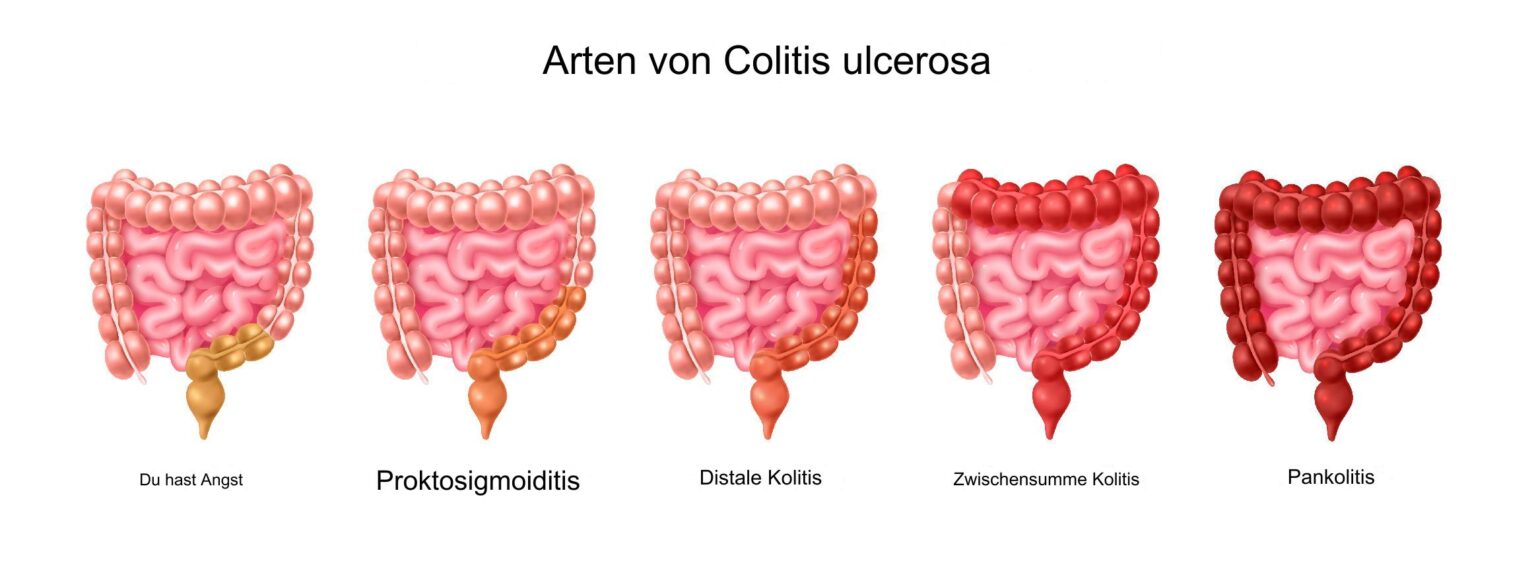 Colitis Ulcerosa heilen: Entzündungsquelle stoppen